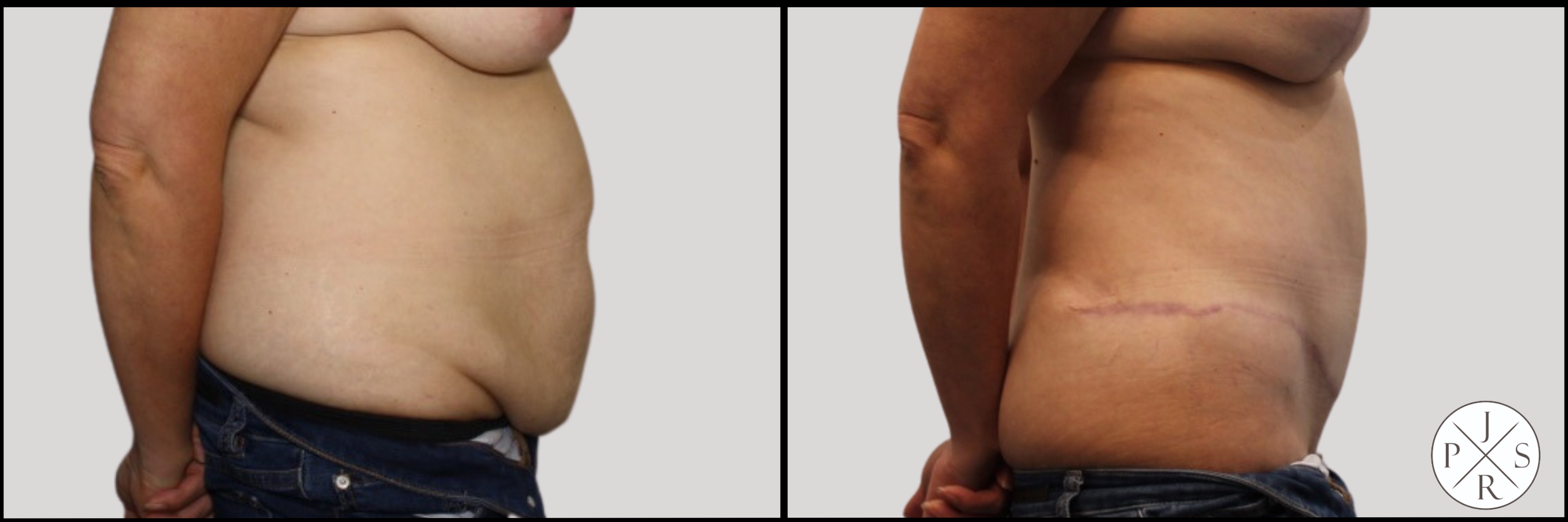 Abdominoplasty Before & After Image